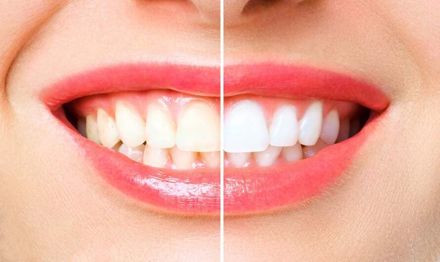 How to take care of teeth whitening?